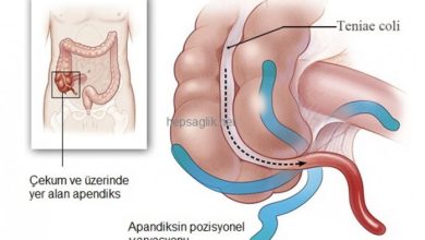 Akut Apandisit nedir?