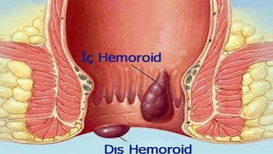 Ameliyatsız Hemoroid Tedavisi