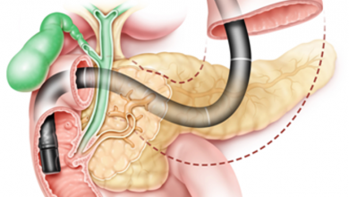 ERCP