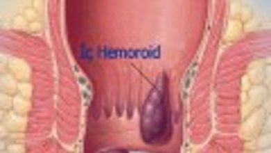 Hemoroid (basur) nedir ?