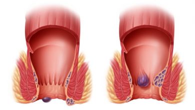 Hemoroid hakkında neler biliyoruz?