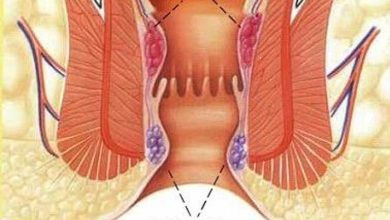 HEMOROİD HASTALIĞI