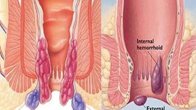 HEMOROİD HASTALIĞI NEDİR?