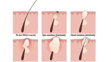 Kıl dönmesi nedir ? ( Pilonidal sinüs )