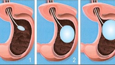 Mide Balonu (Gastric Balloon)