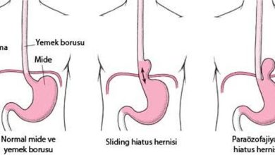 Mide Fıtığı (Hiatal herni) ve Reflü Hastalığı