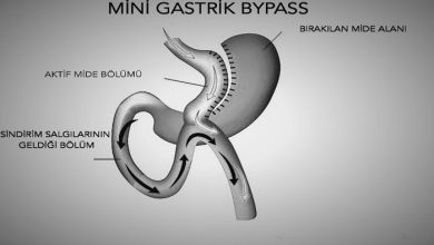 Minigastrik Bypass Ameliyatı