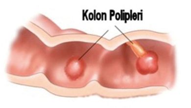 Poliper ve Kolon Kanseri