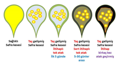 Safra Kesesi Ameliyatı Deyip Geçmeyin! Çok Önemli Noktalar Var!