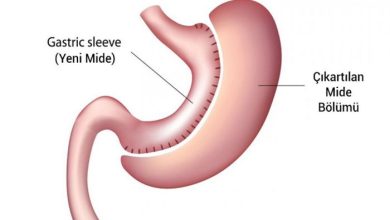 Sleeve Gastrektomi (Tüp Mide Ameliyatı)