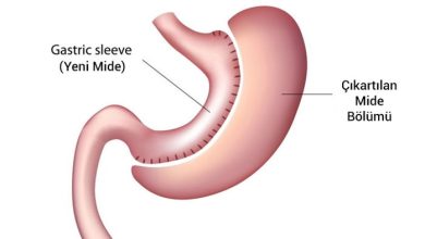Tüp Mide Ameliyatı