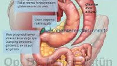 Tüp Mide Ameliyatı ile Obezite Cerrahisi