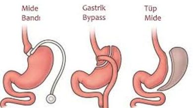Tüp Mide Ameliyatı Sonrası Beslenme