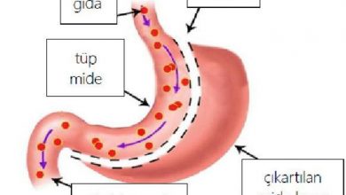 Tüp Mide Ameliyatı Sonrası