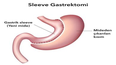 Tüp Mide (Sleeve Gastrektomi) Nedir?