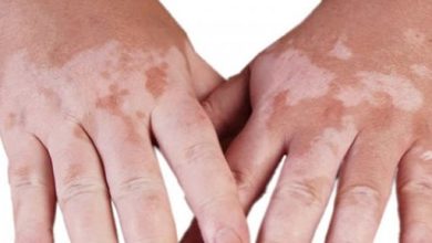 Vitiligo